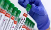 Karnataka reports first Mpox case this year as 40-year-old Dubai returnee tests positive Karnataka reports first Mpox case this year as 40-year-old Dubai returnee tests positive